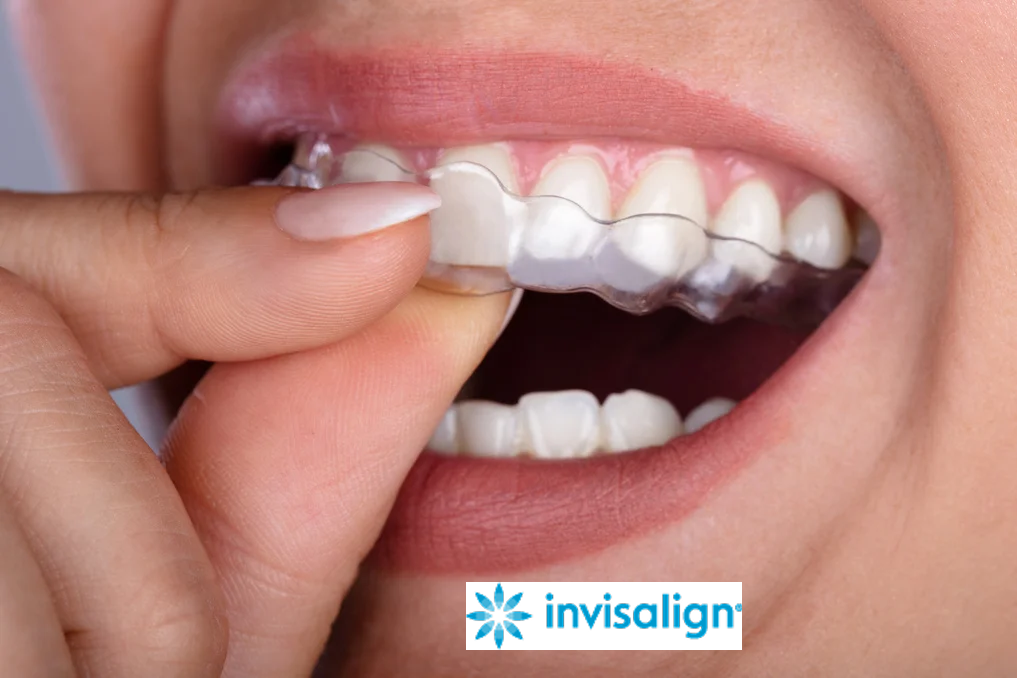 Clear Invisalign aligner with Invisalign brand logo