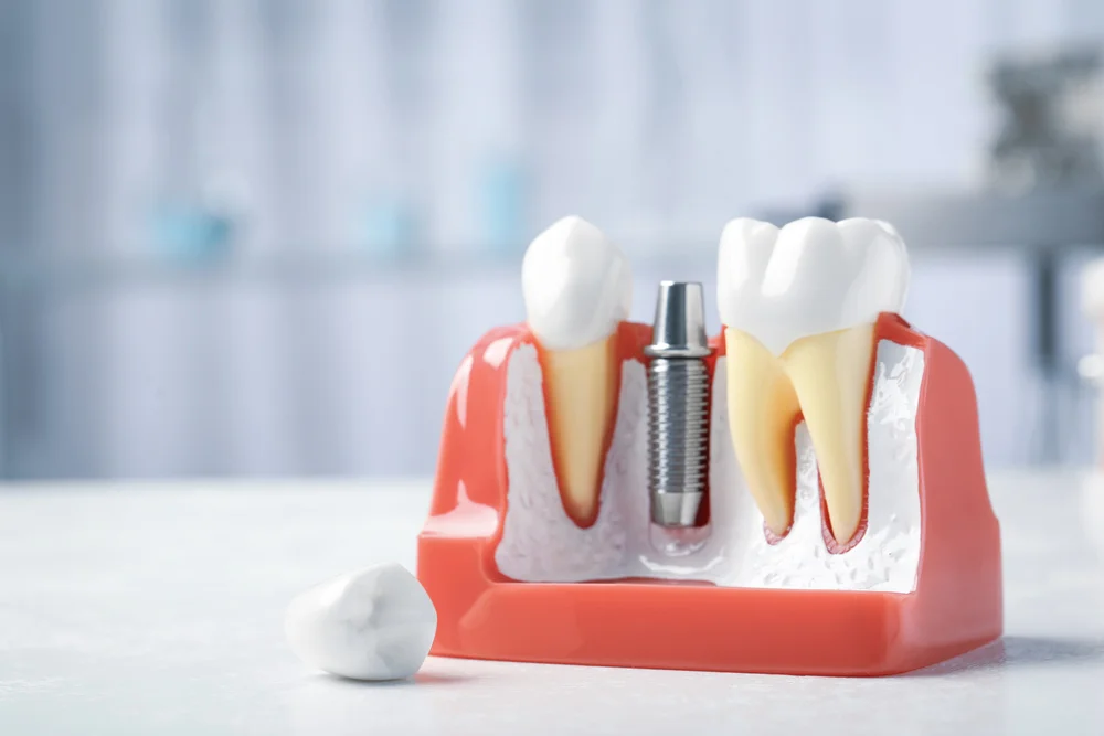 Dental implant restoration with implant post and abutment