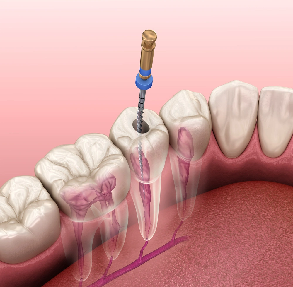 Illustration of root canal treatment using an endodontic instrument