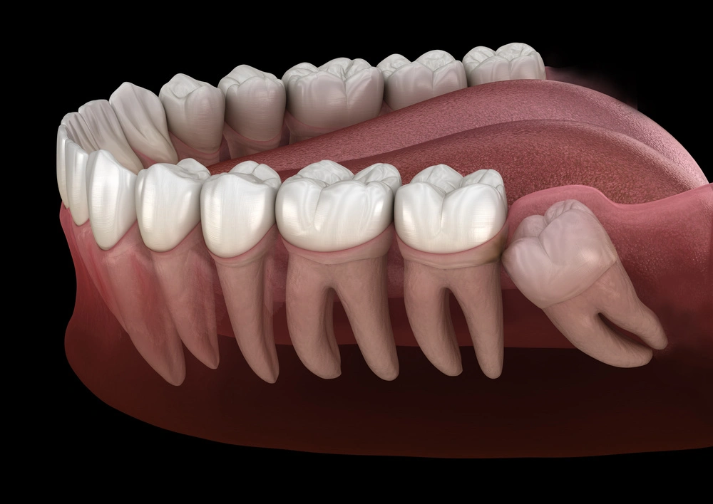 Teeth wisdom