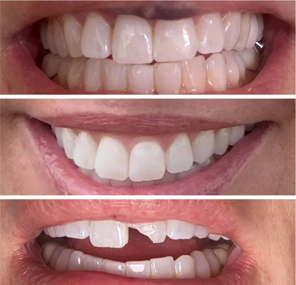 Before and after broken tooth repair at Clear Path Dentistry