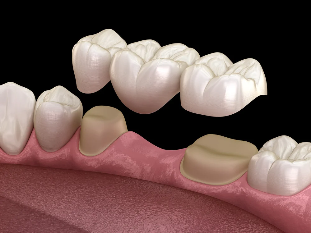 Traditional dental bridge supported by natural teeth